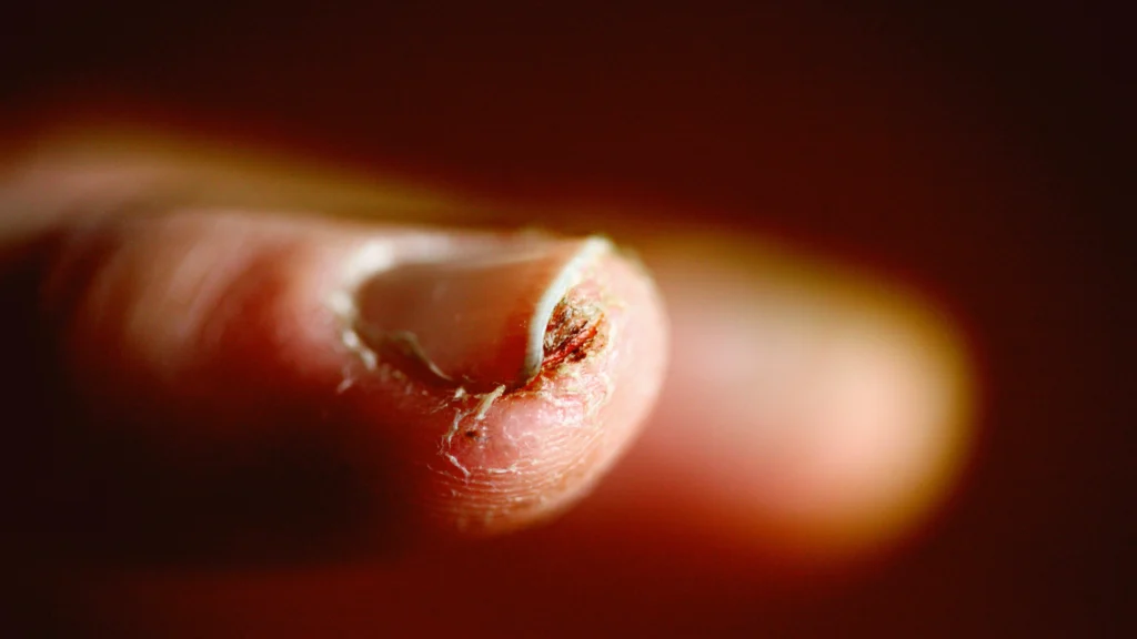 A close-up of a finger with a torn or damaged nail, emphasizing the need for proper techniques when learning How to Remove Press-On Nails , revealing exposed skin and rough edges.